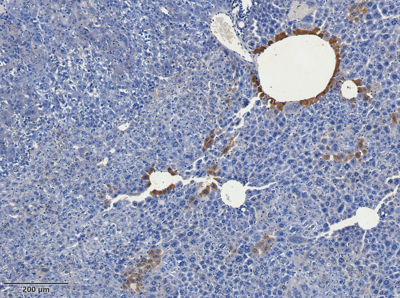 Liver cancer